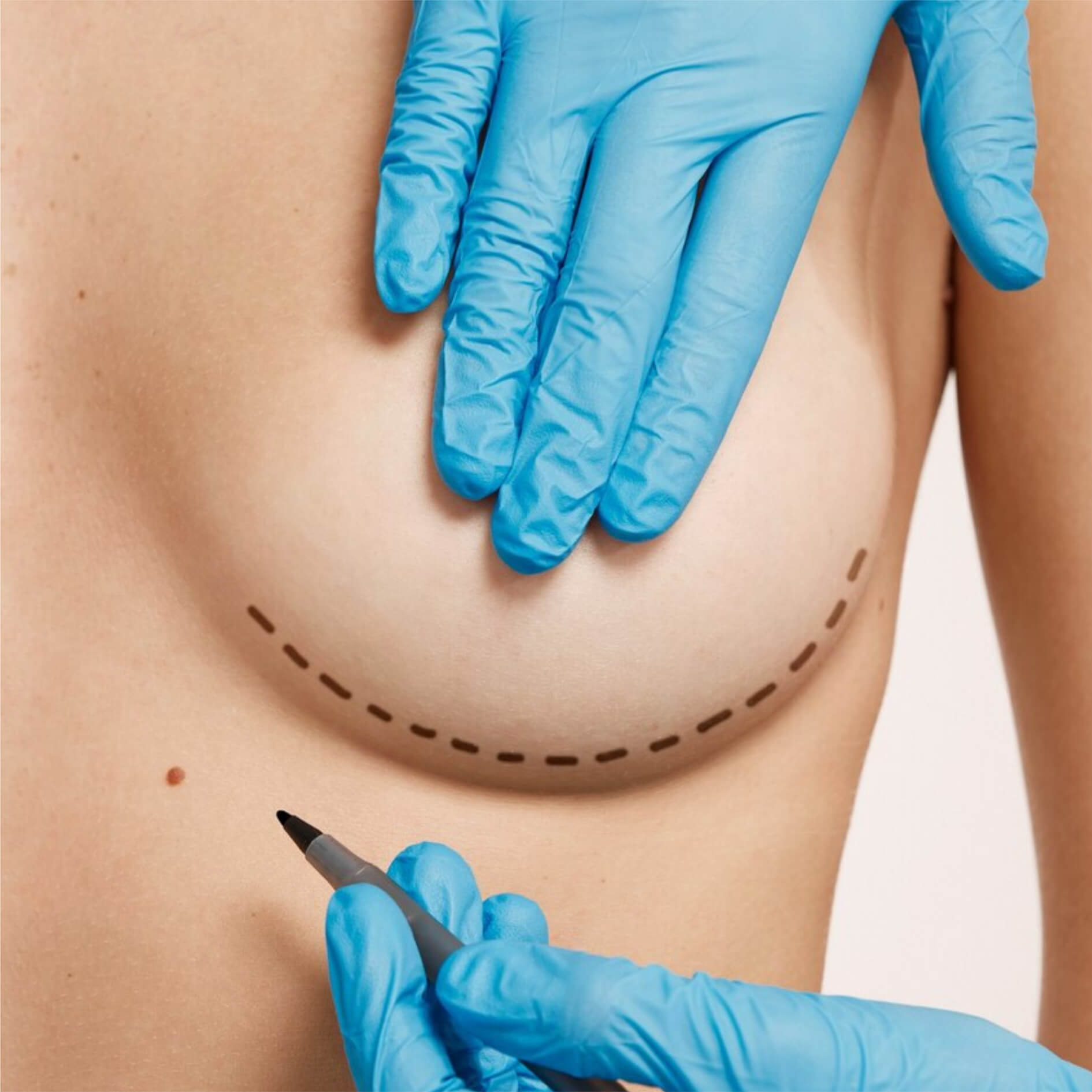 Inclusão de prótese de mama.